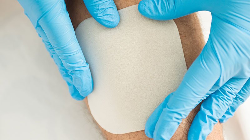 Hydrocolloid Dressings