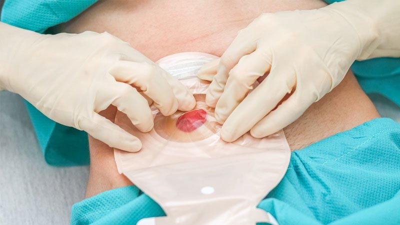 A Complete Guide to Managing Life Comfortably After Ostomy Surgery