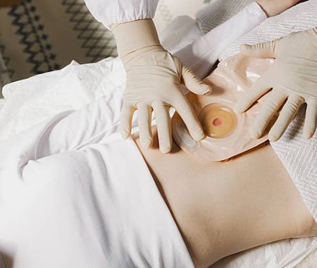 Ostomya care